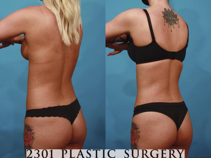 Before & After Liposuction Case 669 Back Left Oblique View in Fort Worth & Frisco, Texas