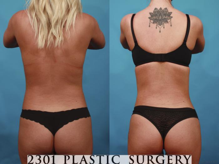 Before & After Liposuction Case 669 Back View in Fort Worth & Frisco, Texas