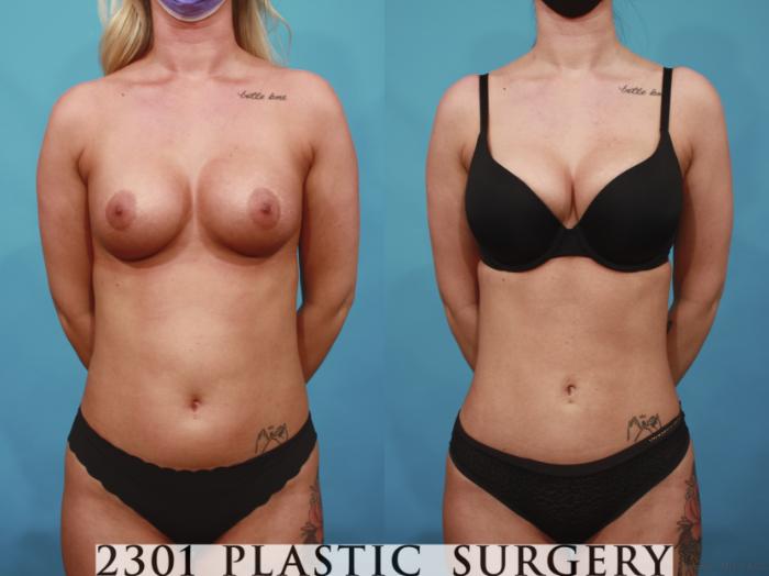 Before & After Liposuction Case 669 Front View in Fort Worth & Frisco, Texas