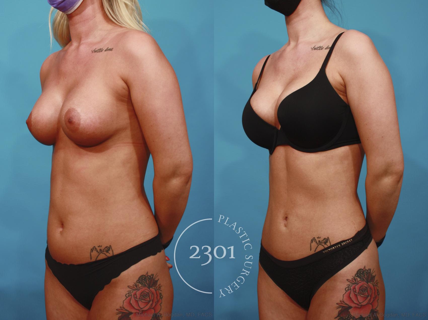 Before & After Liposuction Case 669 Left Oblique View in Fort Worth, Plano, & Frisco, Texas