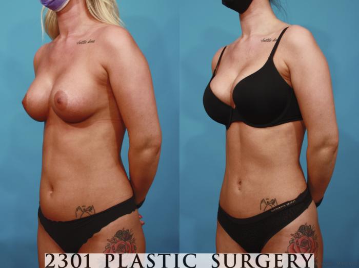 Before & After Liposuction Case 669 Left Oblique View in Fort Worth & Frisco, Texas