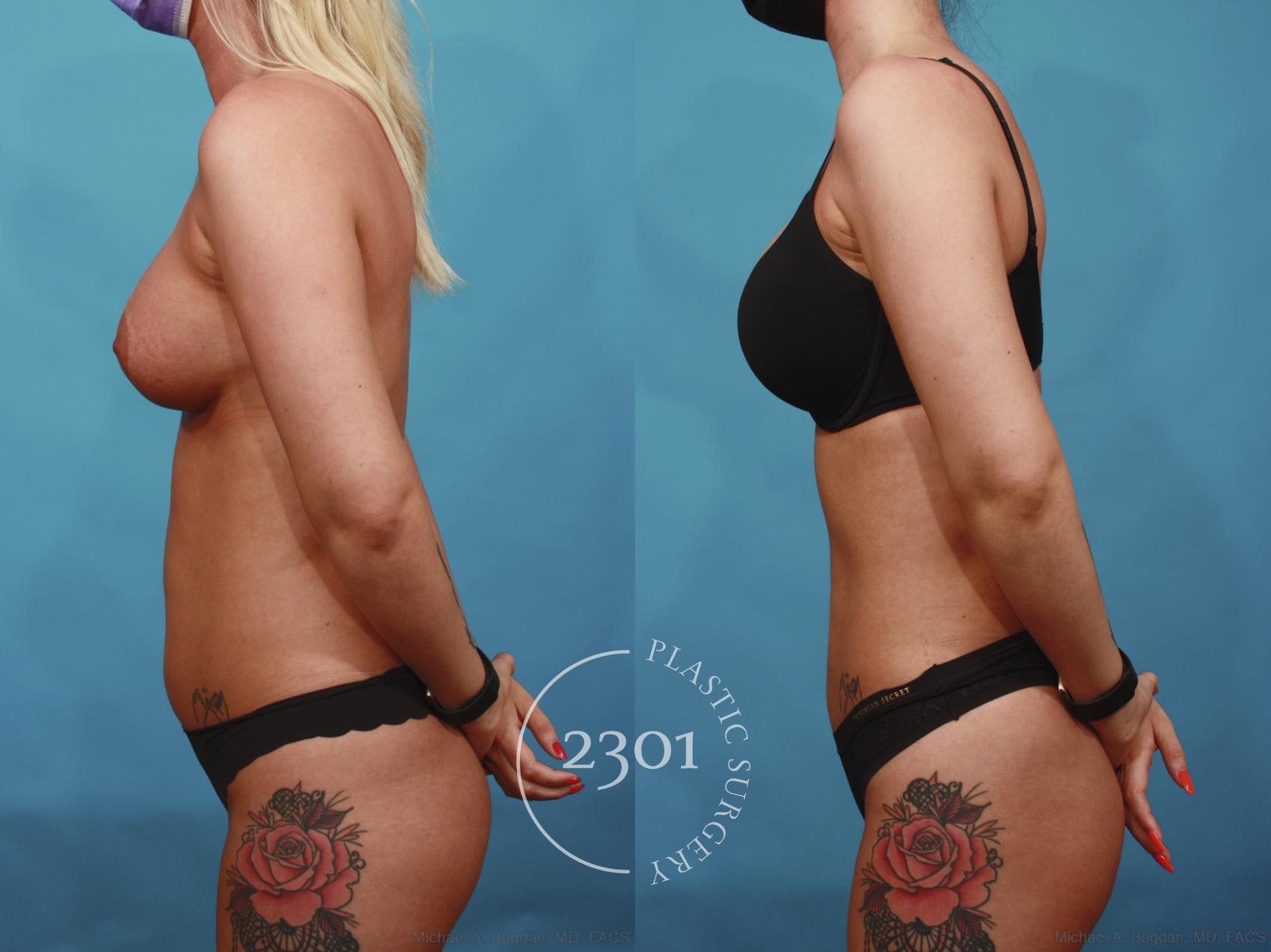 Before & After Liposuction Case 669 Left Side View in Fort Worth, Plano, & Frisco, Texas