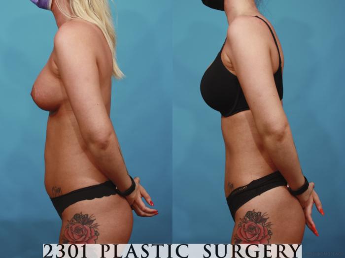 Before & After Liposuction Case 669 Left Side View in Fort Worth & Frisco, Texas