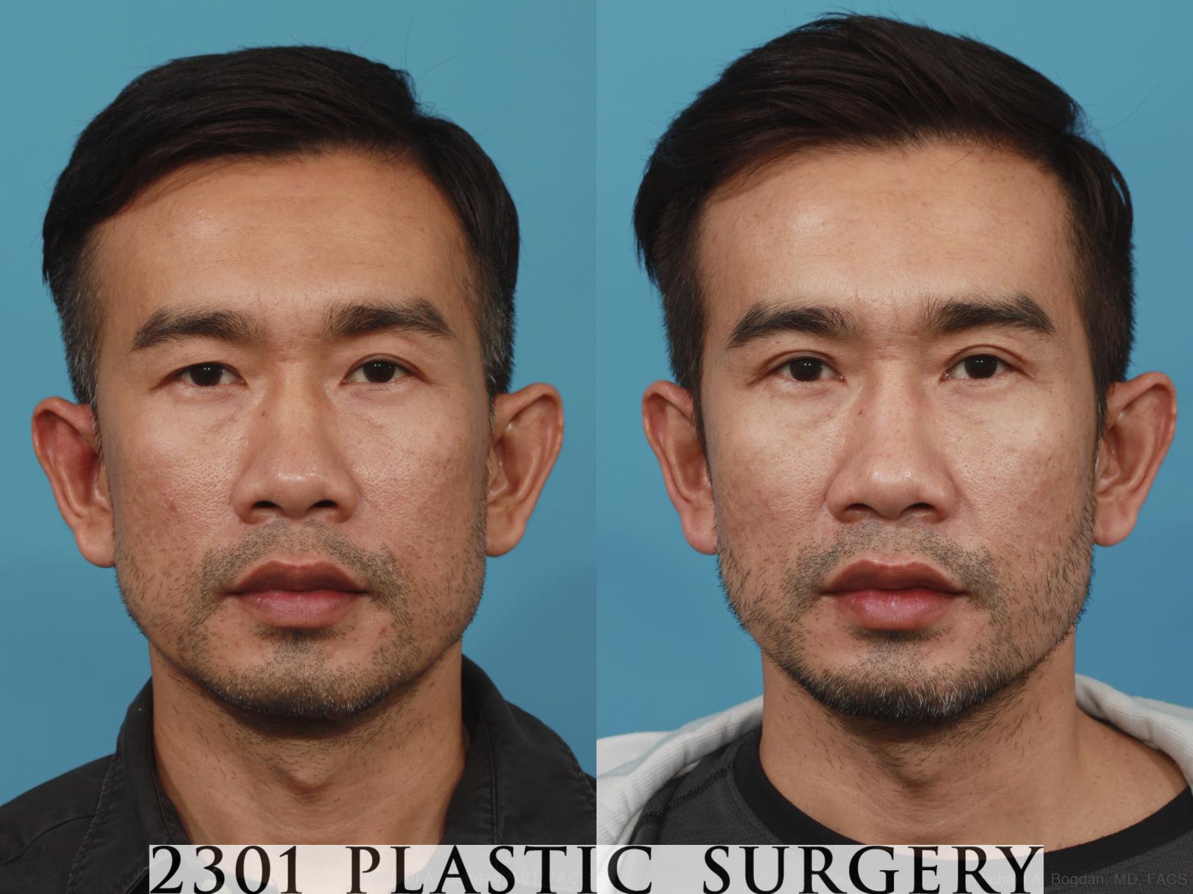 Before & After Male Eyelid Surgery Case 621 Front View in Fort Worth, Plano, & Frisco, Texas