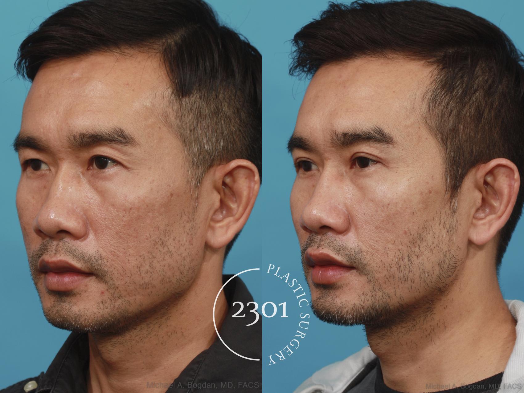 Before & After Male Eyelid Surgery Case 621 Left Oblique View in Fort Worth, Plano, & Frisco, Texas