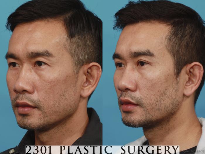 Before & After Male Eyelid Surgery Case 621 Left Oblique View in Fort Worth, Plano, & Frisco, Texas