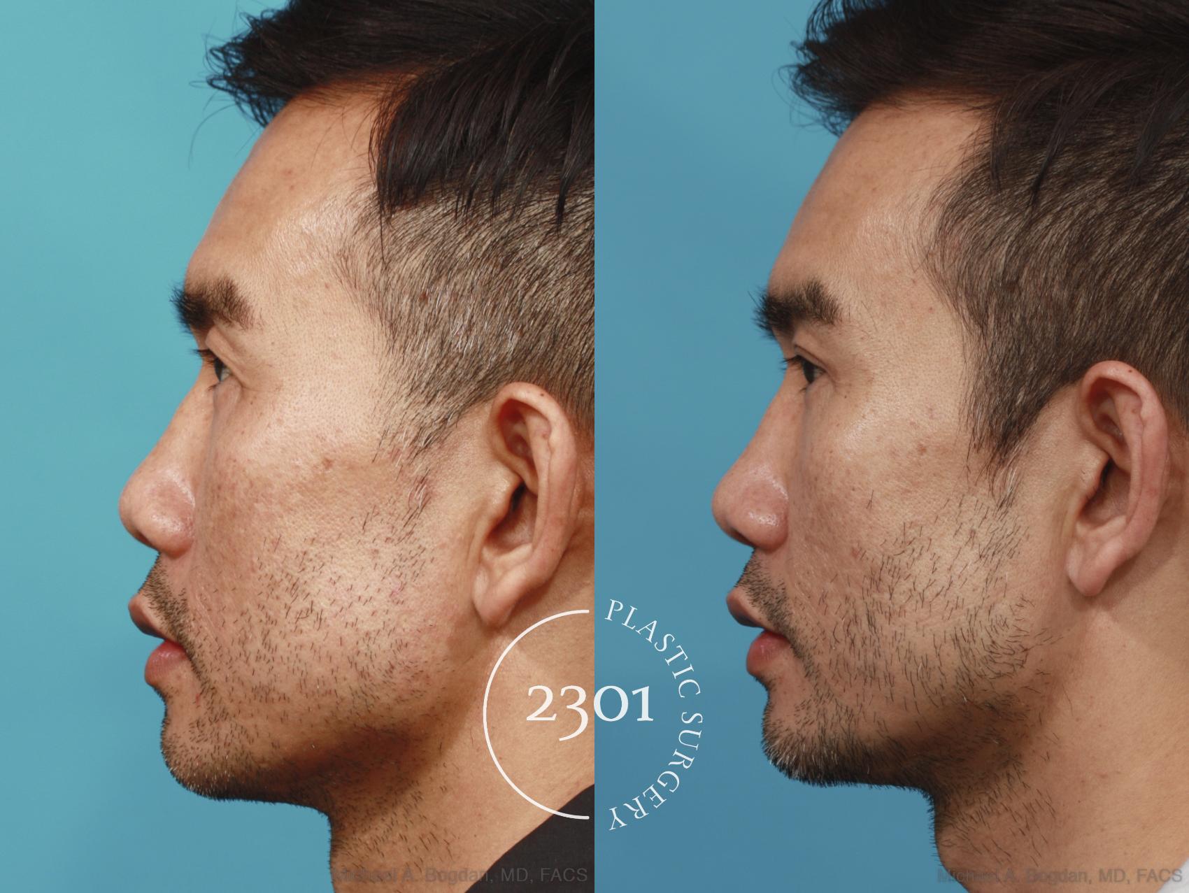 Before & After Male Eyelid Surgery Case 621 Left Side View in Fort Worth, Plano, & Frisco, Texas