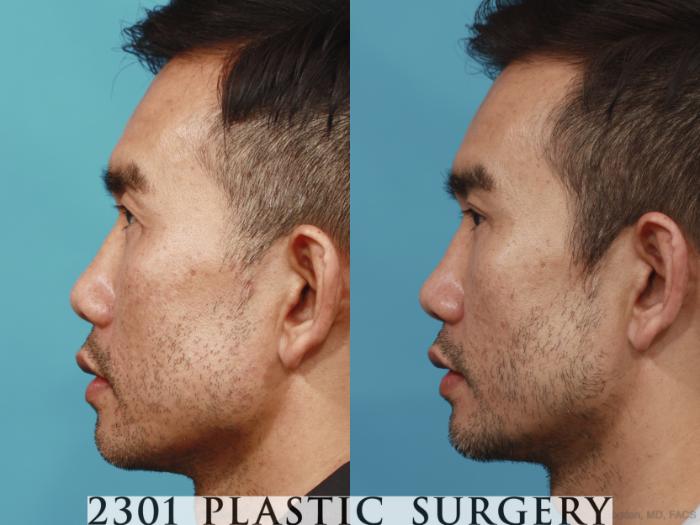 Before & After Male Eyelid Surgery Case 621 Left Side View in Fort Worth, Plano, & Frisco, Texas