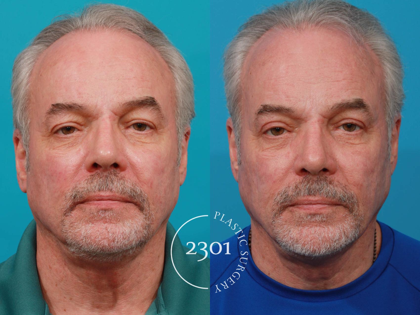 Before & After Male Eyelid Surgery Case 728 Front View in Fort Worth, Plano, & Frisco, Texas