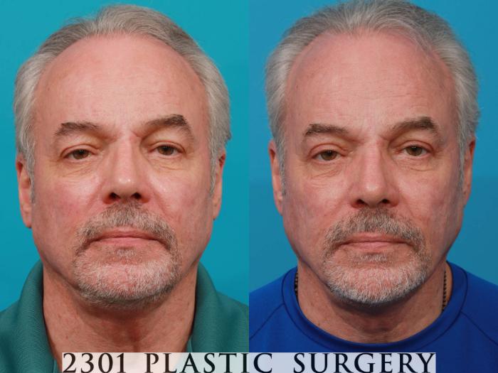 Before & After Male Eyelid Surgery Case 728 Front View in Fort Worth, Plano, & Frisco, Texas