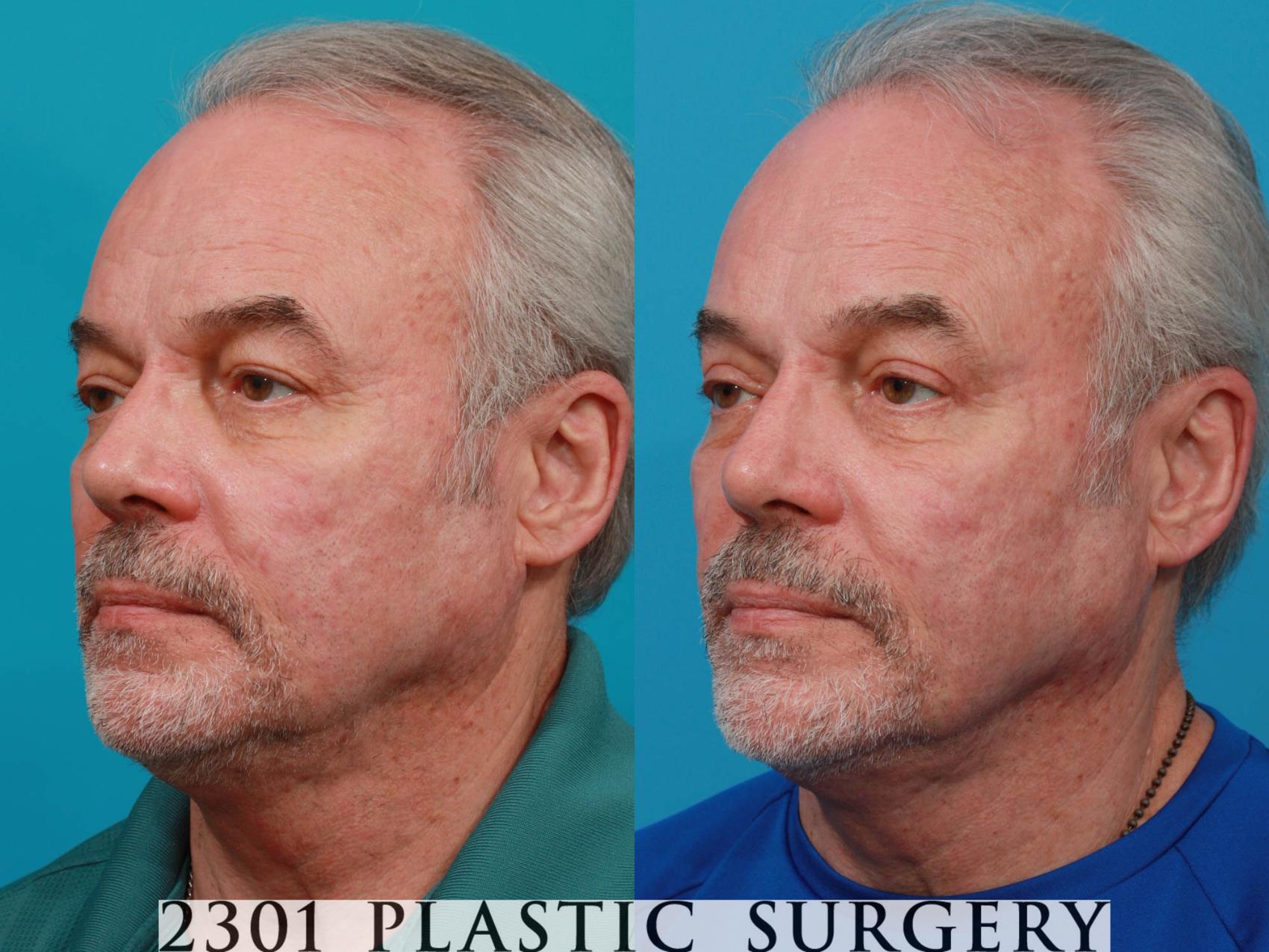 Before & After Male Eyelid Surgery Case 728 Left Oblique View in Fort Worth, Plano, & Frisco, Texas