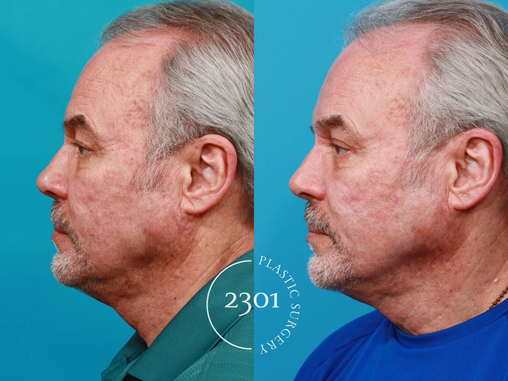 Before & After Male Eyelid Surgery Case 728 Left Side View in Fort Worth, Plano, & Frisco, Texas