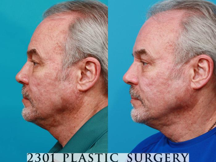 Before & After Male Eyelid Surgery Case 728 Left Side View in Fort Worth, Plano, & Frisco, Texas