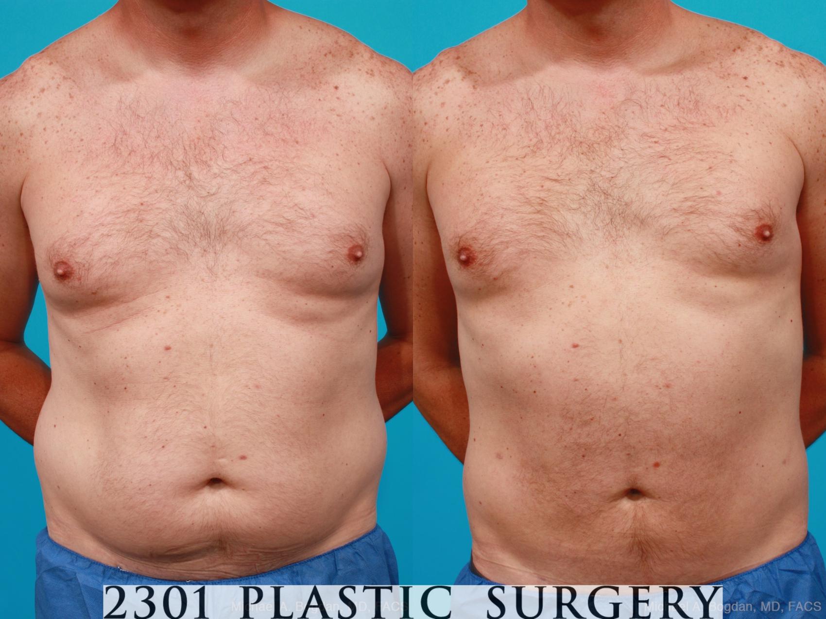 Before & After Male Liposuction Case 160 View #1 View in Fort Worth, Plano, & Frisco, Texas