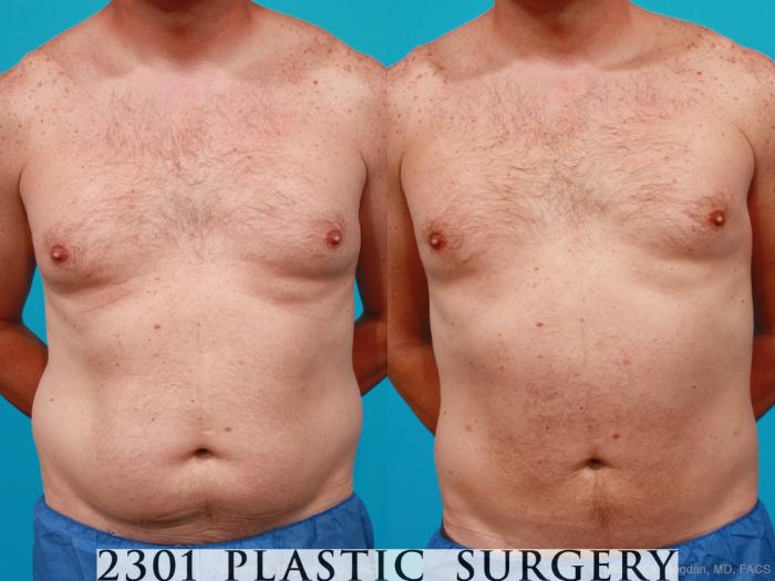 Before & After Male Liposuction Case 160 View #1 View in Fort Worth & Frisco, Texas