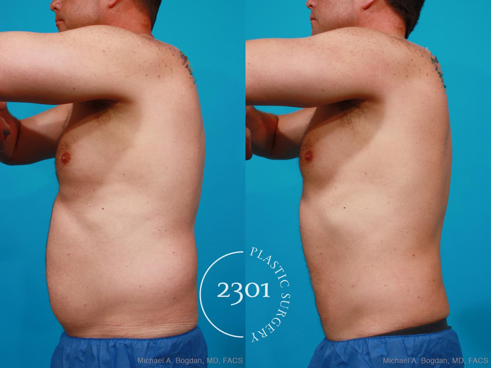Before & After Male Liposuction Case 160 View #2 View in Fort Worth, Plano, & Frisco, Texas