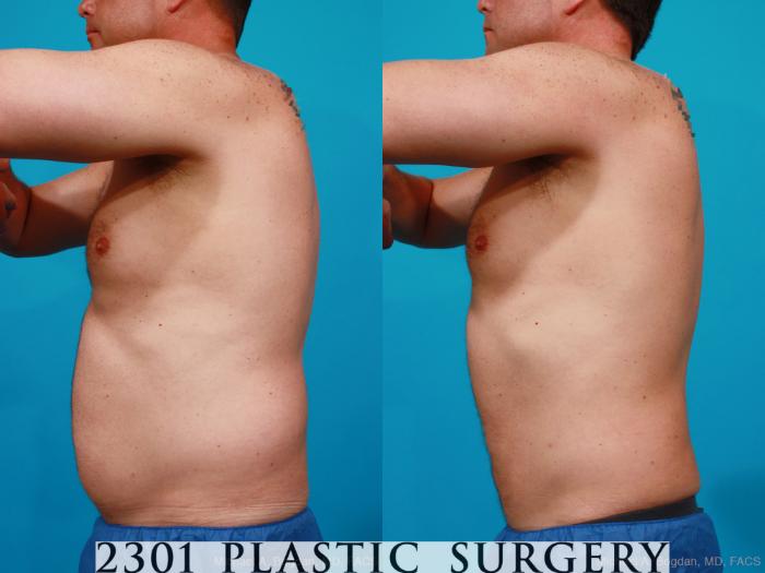 Before & After Male Liposuction Case 160 View #2 View in Fort Worth, Plano, & Frisco, Texas