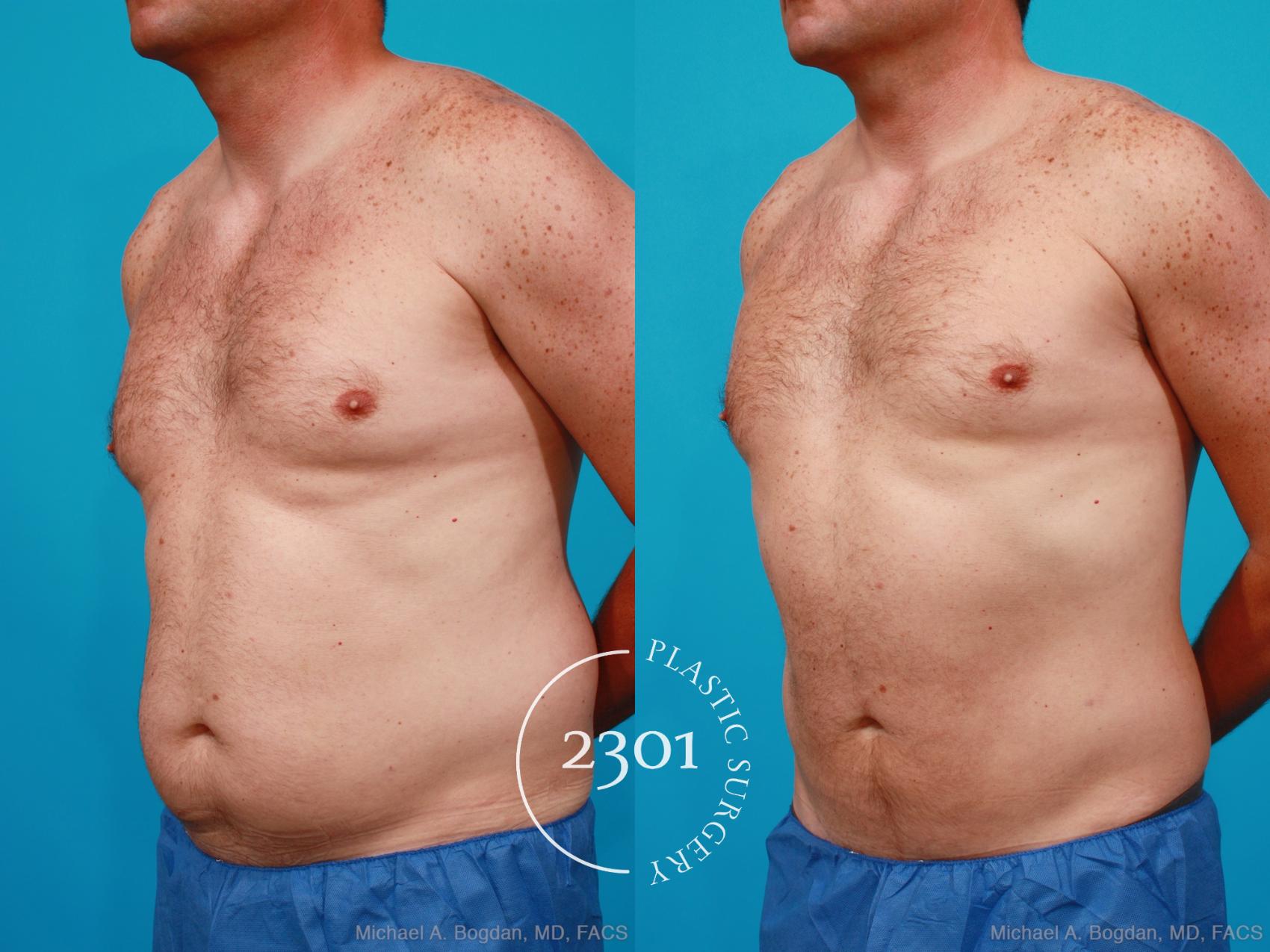 Before & After Male Liposuction Case 160 View #3 View in Fort Worth, Plano, & Frisco, Texas