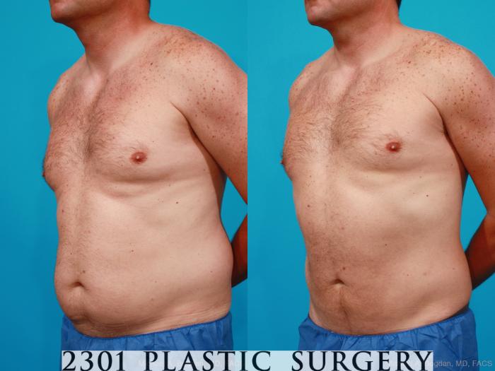 Before & After Male Liposuction Case 160 View #3 View in Fort Worth, Plano, & Frisco, Texas