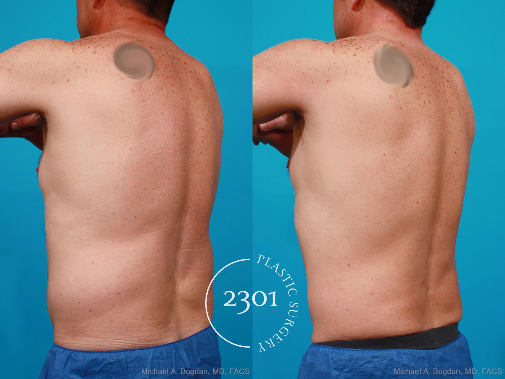 Before & After Male Liposuction Case 160 View #4 View in Fort Worth, Plano, & Frisco, Texas