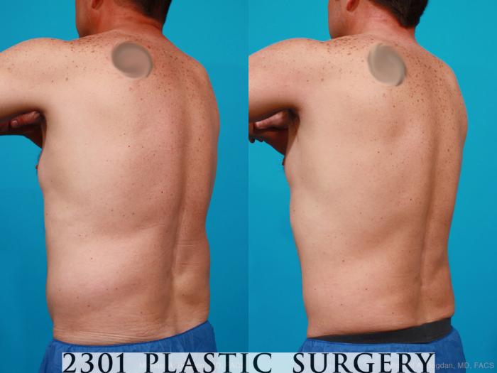 Before & After Male Liposuction Case 160 View #4 View in Fort Worth, Plano, & Frisco, Texas