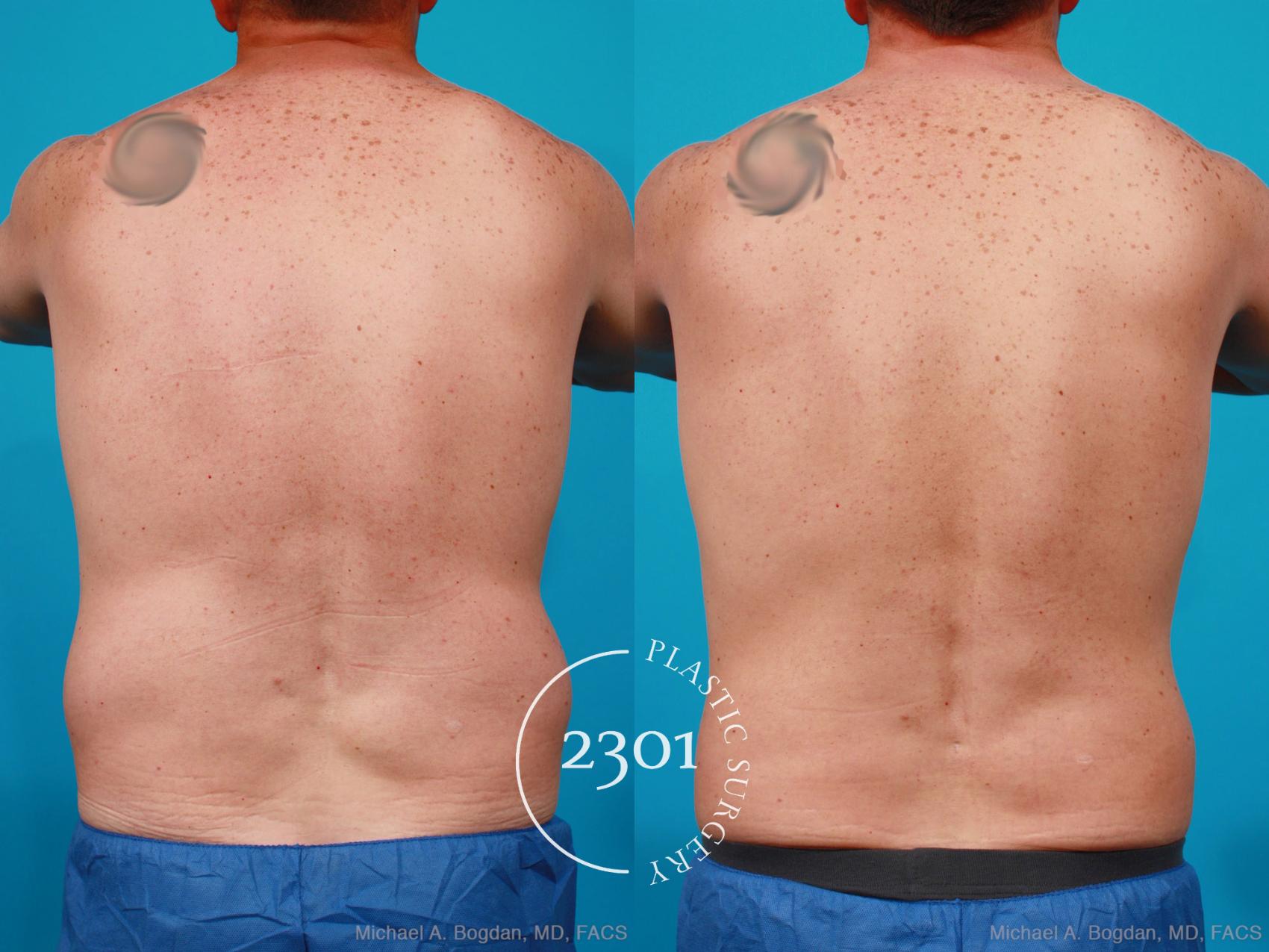 Before & After Male Liposuction Case 160 View #5 View in Fort Worth, Plano, & Frisco, Texas