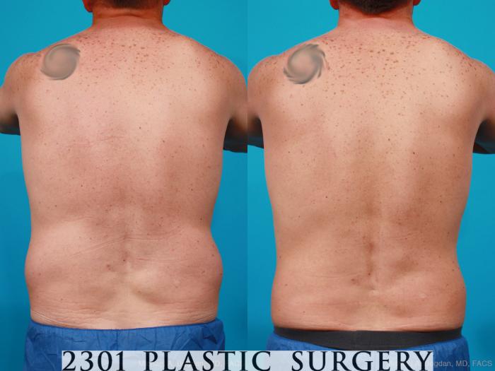 Before & After Male Liposuction Case 160 View #5 View in Fort Worth, Plano, & Frisco, Texas