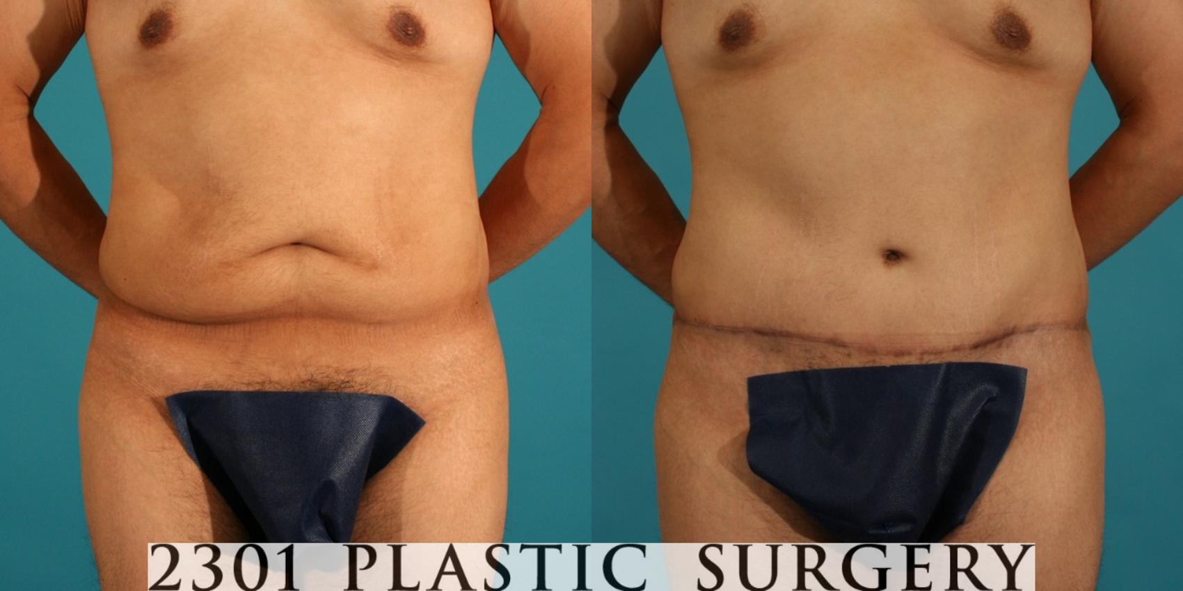 Before & After Male Tummy Tuck Case 46 View #1 View in Fort Worth, Plano, & Frisco, Texas