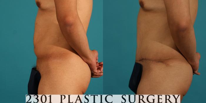 Before & After Male Tummy Tuck Case 46 View #2 View in Fort Worth, Plano, & Frisco, Texas