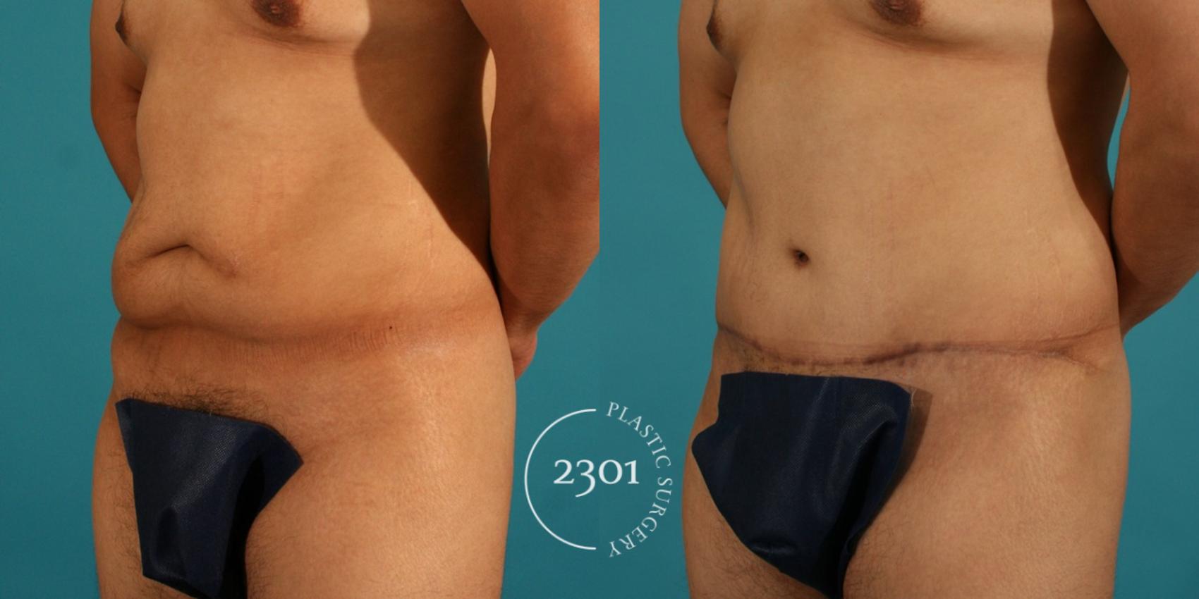 Before & After Male Tummy Tuck Case 46 View #3 View in Fort Worth, Plano, & Frisco, Texas