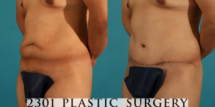 Before & After Male Tummy Tuck Case 46 View #3 View in Fort Worth, Plano, & Frisco, Texas