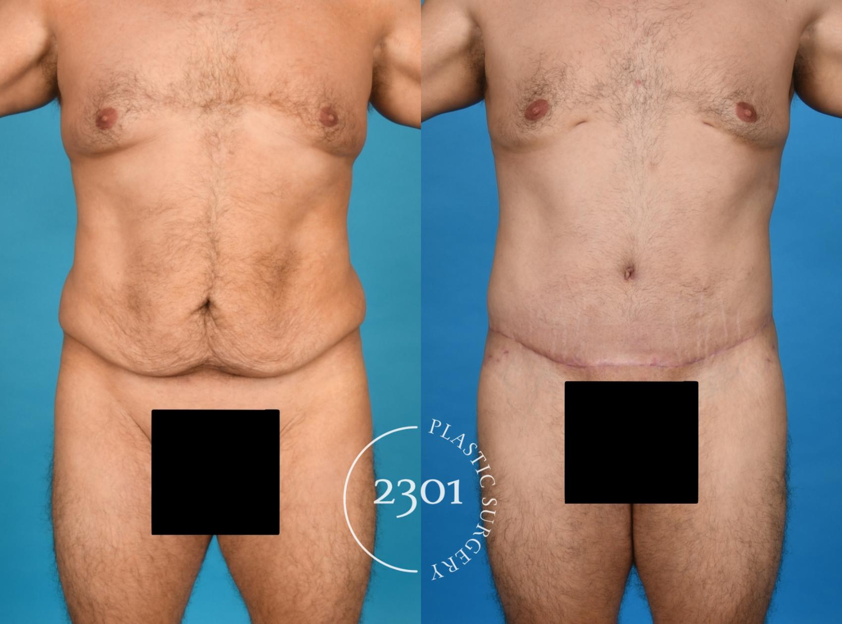 Before & After Male Tummy Tuck Case 754 Front View in Fort Worth, Plano, & Frisco, Texas