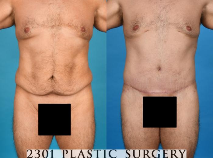 Before & After Male Tummy Tuck Case 754 Front View in Fort Worth & Frisco, Texas