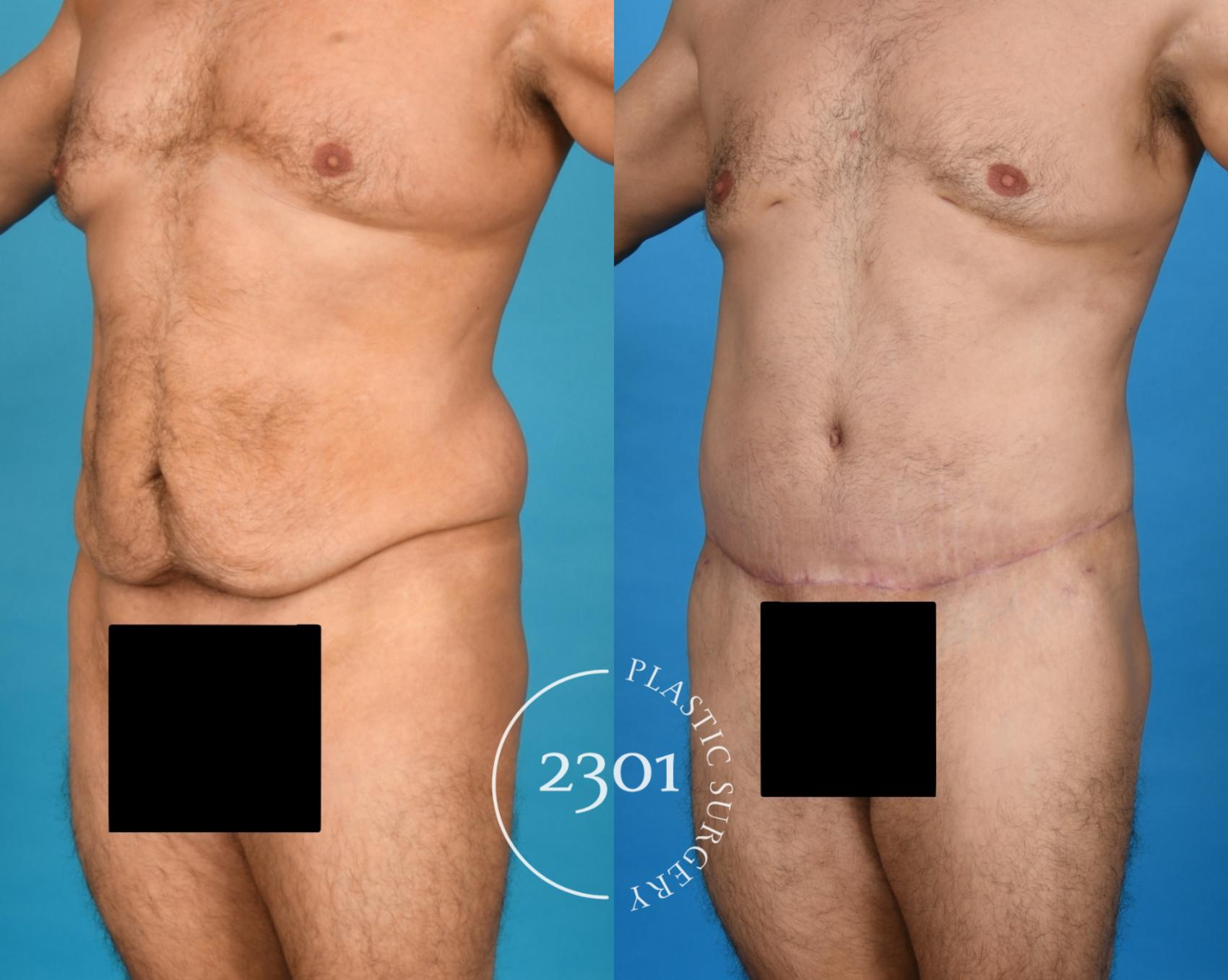 Before & After Gynecomastia (Chest Contouring) Case 754 Left Oblique View in Fort Worth, Plano, & Frisco, Texas