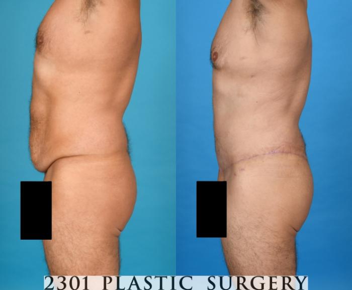 Before & After Male Tummy Tuck Case 754 Left Side View in Fort Worth, Plano, & Frisco, Texas