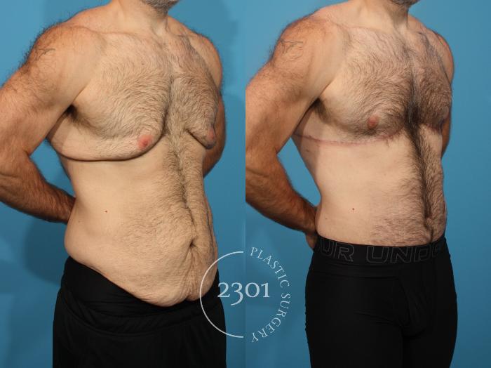 Before & After Male Tummy Tuck Case 883 Right Oblique View in Fort Worth, Plano, & Frisco, Texas