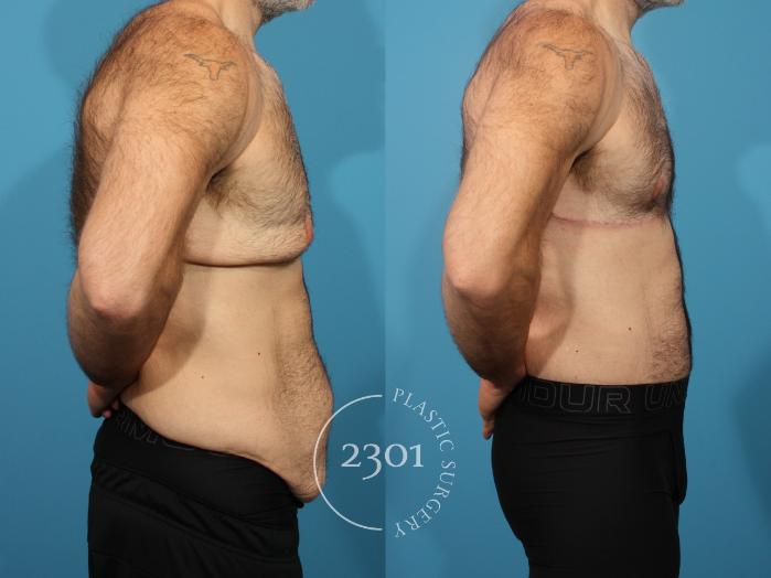 Before & After Male Tummy Tuck Case 883 Right Side View in Fort Worth, Plano, & Frisco, Texas