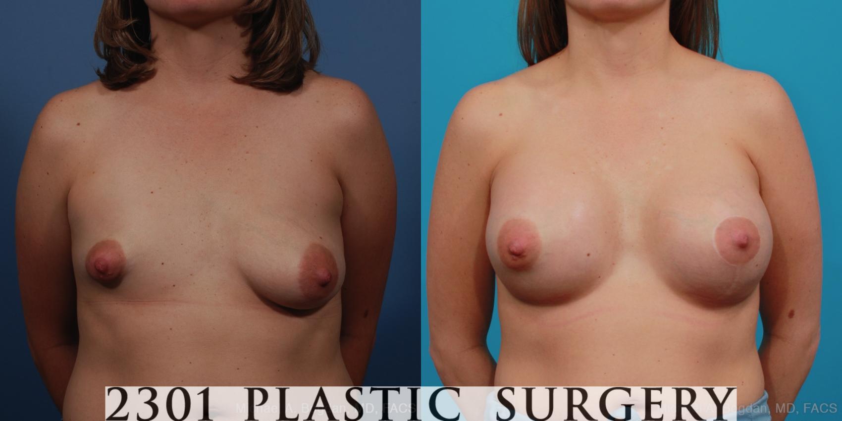 Before & After Mastopexy & Augmentation Case 340 View #1 View in Fort Worth, Plano, & Frisco, Texas