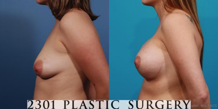 Before & After Mastopexy & Augmentation Case 340 View #2 View in Fort Worth, Plano, & Frisco, Texas