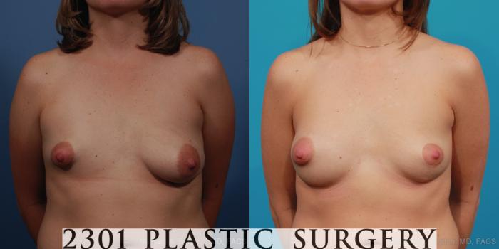 Before & After Mastopexy & Augmentation Case 340 View #3 View in Fort Worth, Plano, & Frisco, Texas