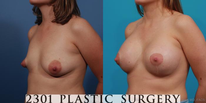 Before & After Mastopexy & Augmentation Case 340 View #4 View in Fort Worth, Plano, & Frisco, Texas