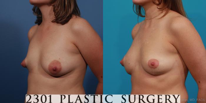 Before & After Mastopexy & Augmentation Case 340 View #5 View in Fort Worth, Plano, & Frisco, Texas