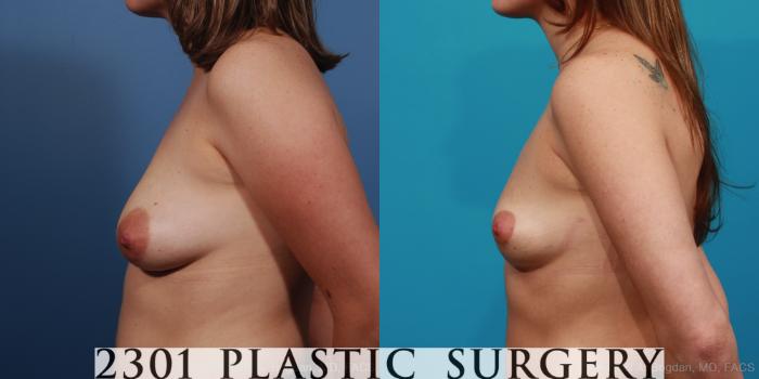 Before & After Mastopexy & Augmentation Case 340 View #6 View in Fort Worth, Plano, & Frisco, Texas