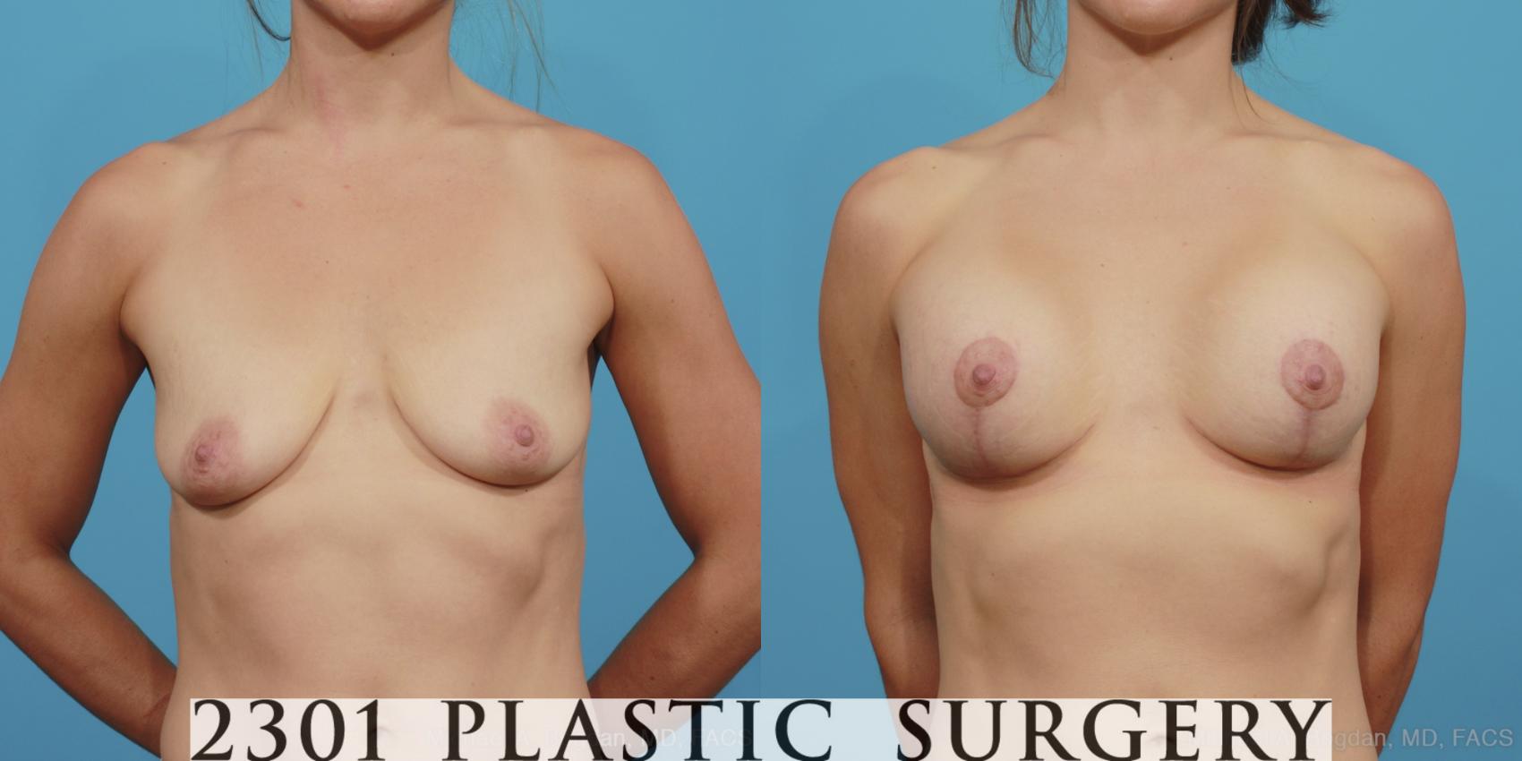 Before & After Mastopexy & Augmentation Case 375 View #1 View in Fort Worth, Plano, & Frisco, Texas