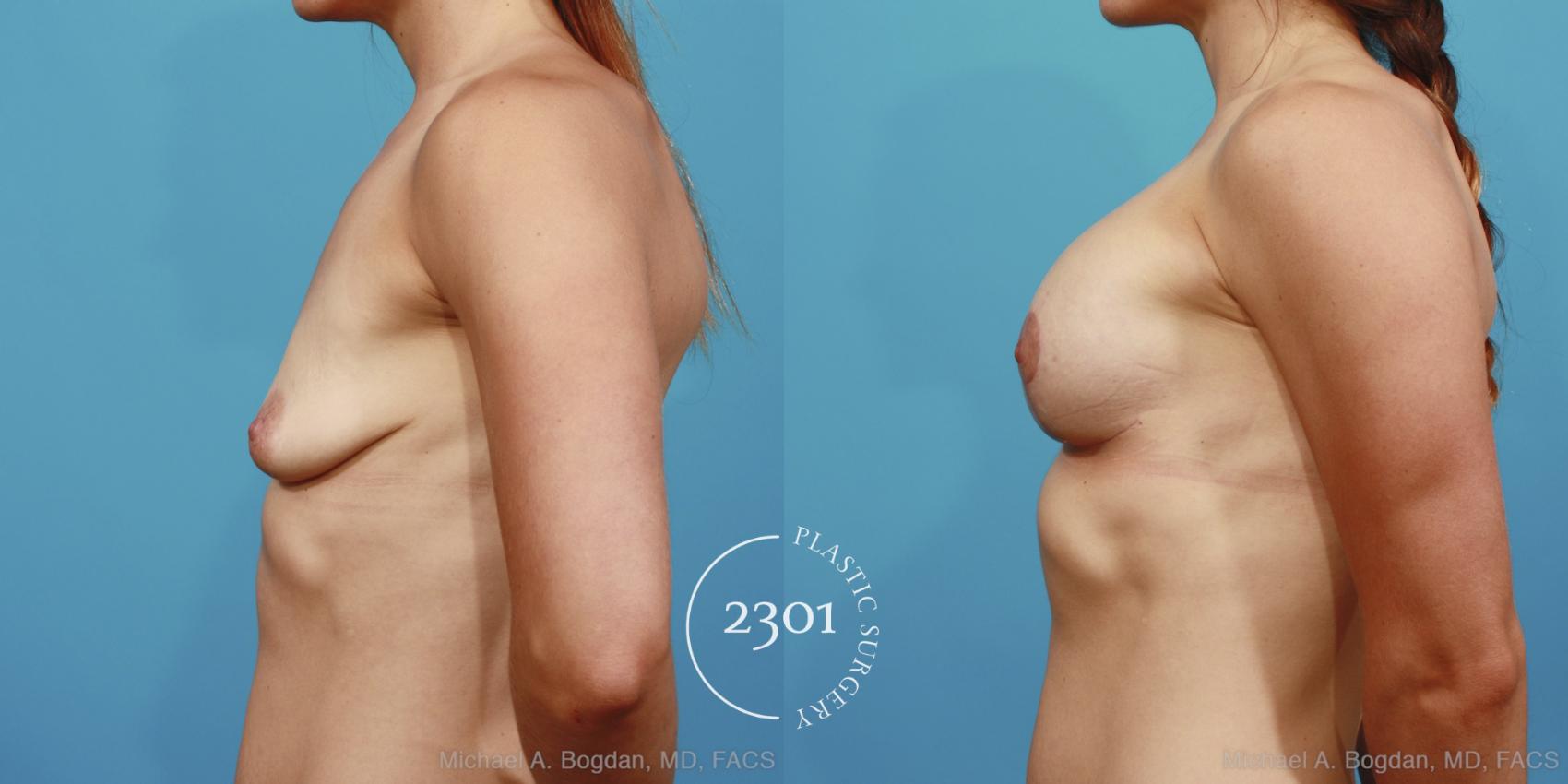 Before & After Mastopexy & Augmentation Case 375 View #2 View in Fort Worth, Plano, & Frisco, Texas