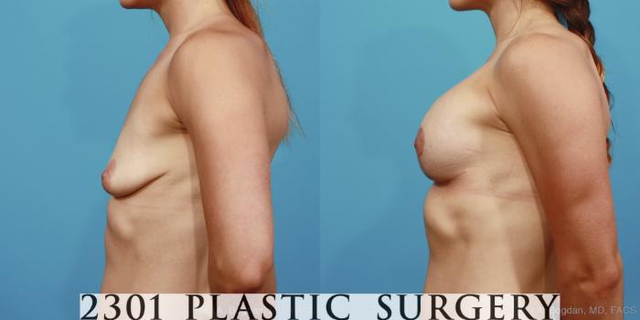 Before & After Mastopexy & Augmentation Case 375 View #2 View in Fort Worth, Plano, & Frisco, Texas