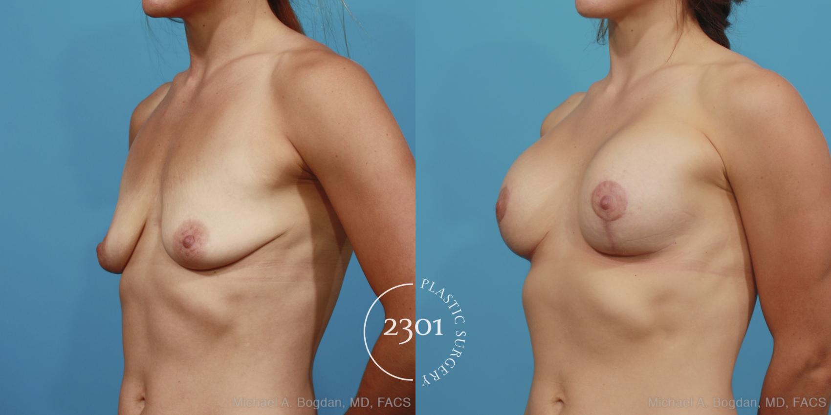 Before & After Mastopexy & Augmentation Case 375 View #3 View in Fort Worth, Plano, & Frisco, Texas