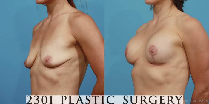 Before & After Mastopexy & Augmentation Case 375 View #3 View in Fort Worth, Plano, & Frisco, Texas