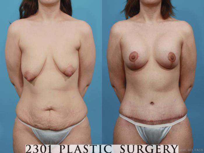 Before & After Mastopexy & Augmentation Case 377 View #1 View in Fort Worth, Plano, & Frisco, Texas