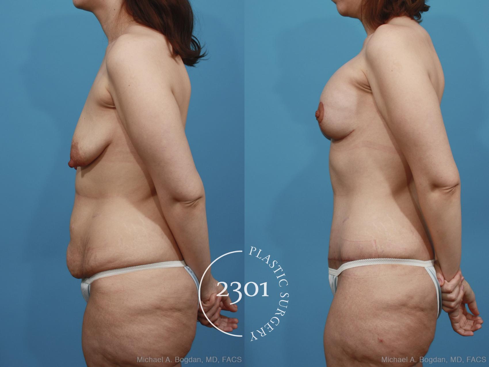 Before & After Mommy Makeover Case 377 View #2 View in Fort Worth, Plano, & Frisco, Texas